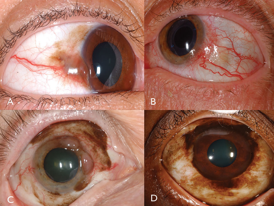 Fig. 3. Pigmented conjunctival melanoma can arise from PAM (A). Non-pigmented conjunctival melanoma may have intense vascularity (B). PAM could also cause mixed pigmented/non-pigmented conjunctival melanoma (C). PAM caused limbal melanoma in this African-American patient (D).