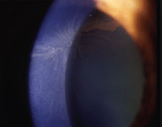 Amiodarone causes corneal verticillata.