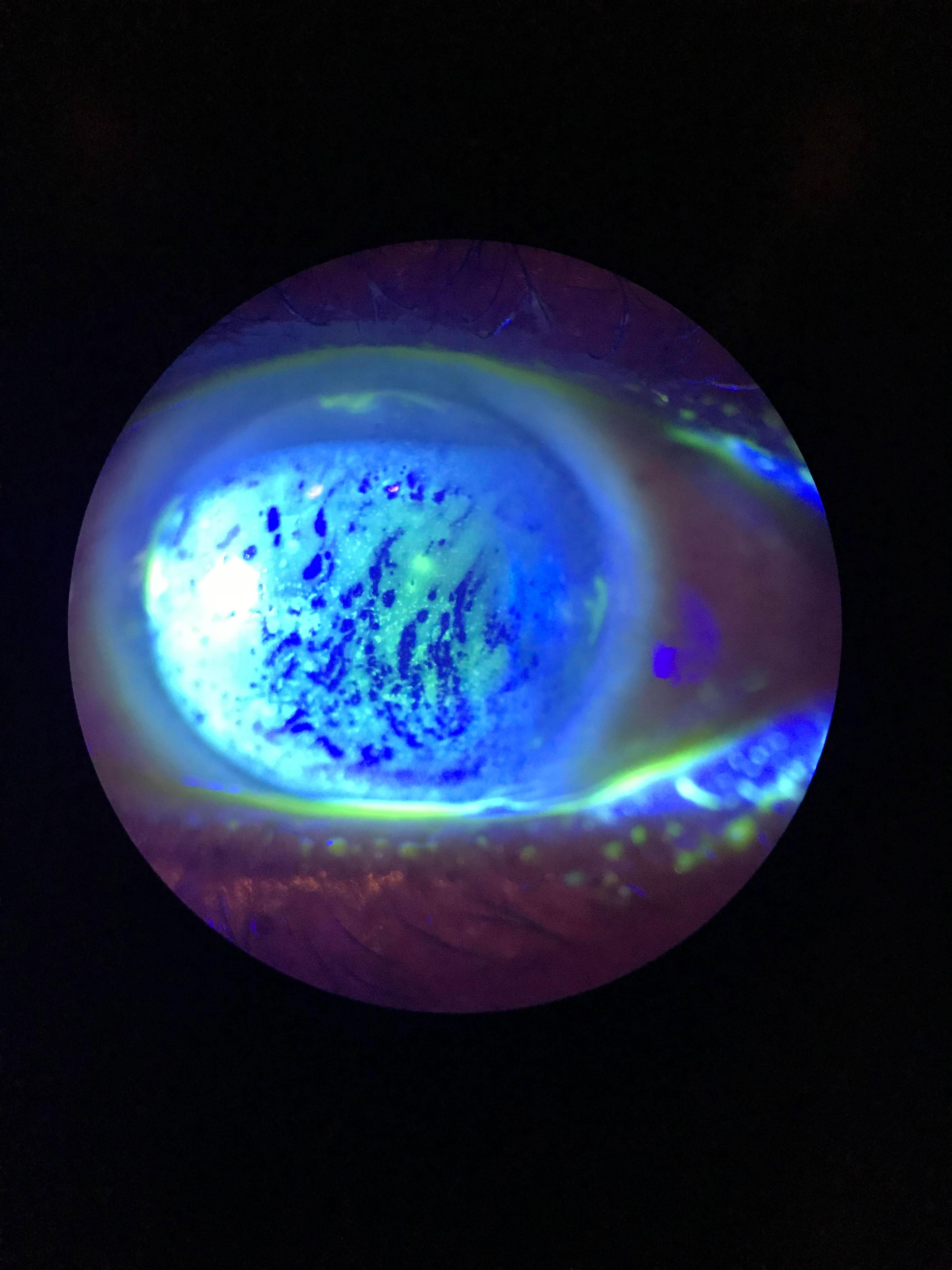 This patient displays diffuse superficial punctate keratitis (SPK) with a decreased TBUT.
