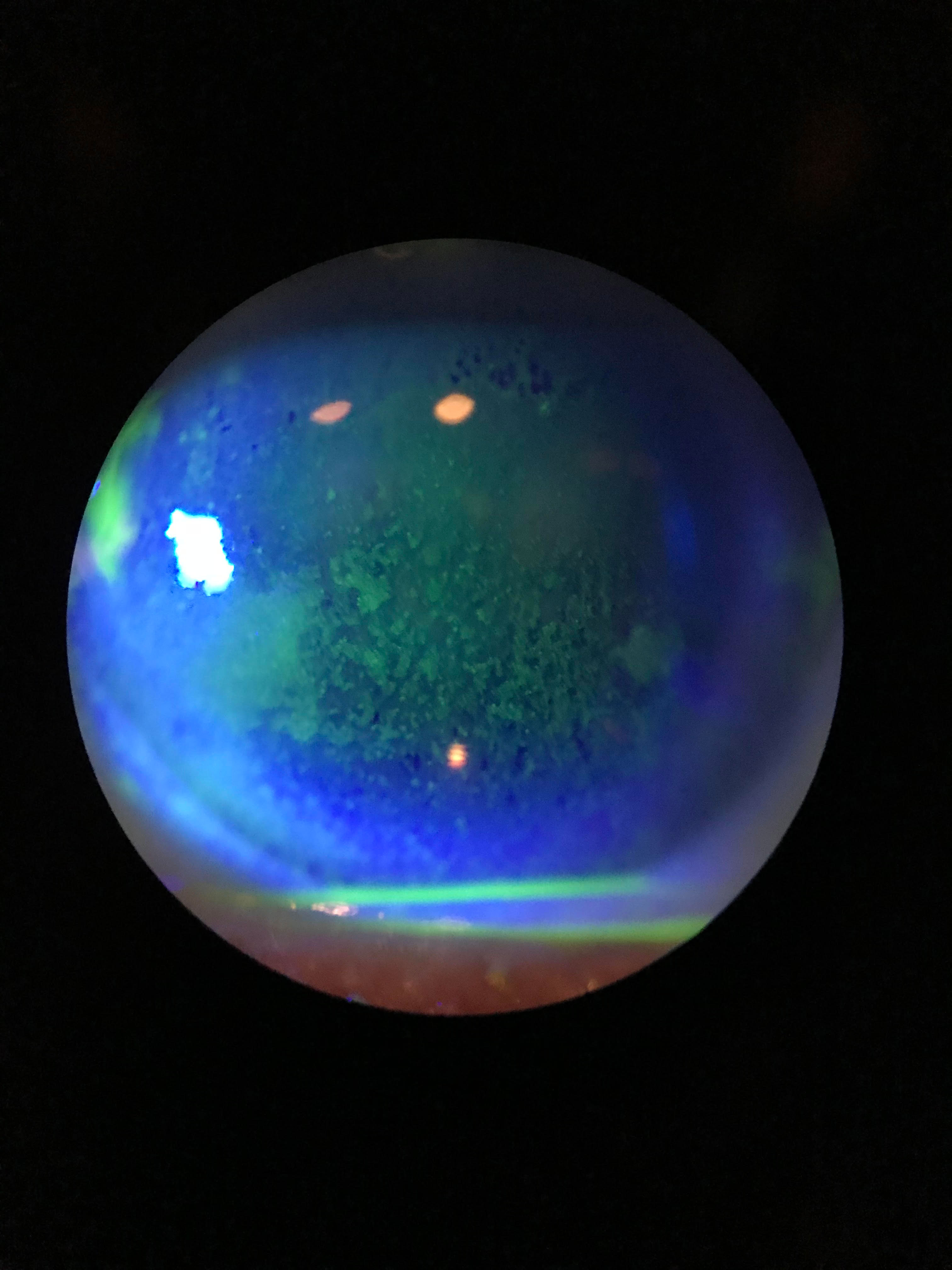 Staining shows this dry eye patient’s diffuse dense superficial punctate keratitis.