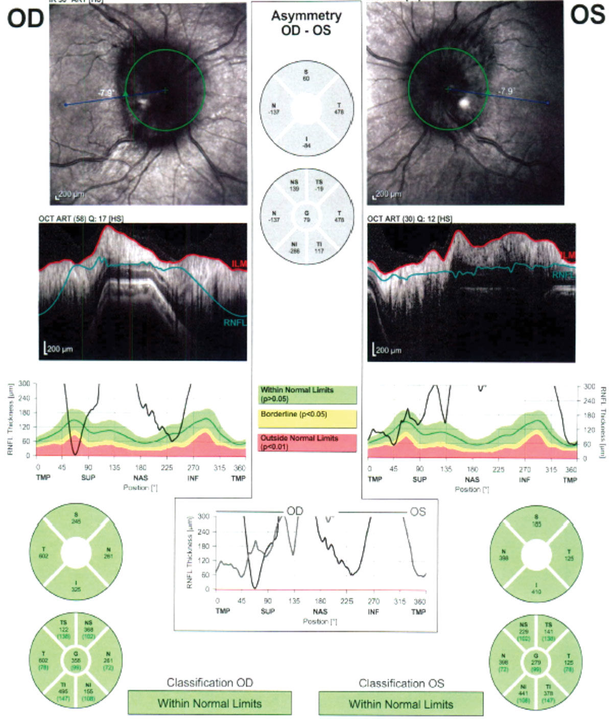 Fig. 1. SD-OCT revealed peripapillary retinal nerve fiber layer thickening in both eyes. 