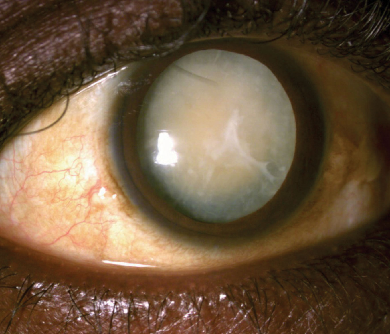 This 53-year-old patient’s left eye’s vision was reduced to light perception as a result of this hypermature cataract.
