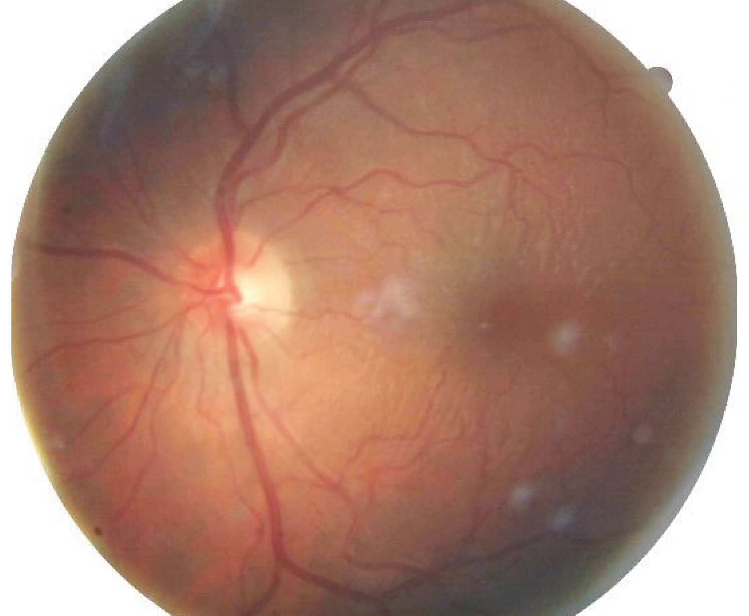 Fig. 2. This fundus image shows circular, radial striae concentrated within the macular aspect. 
