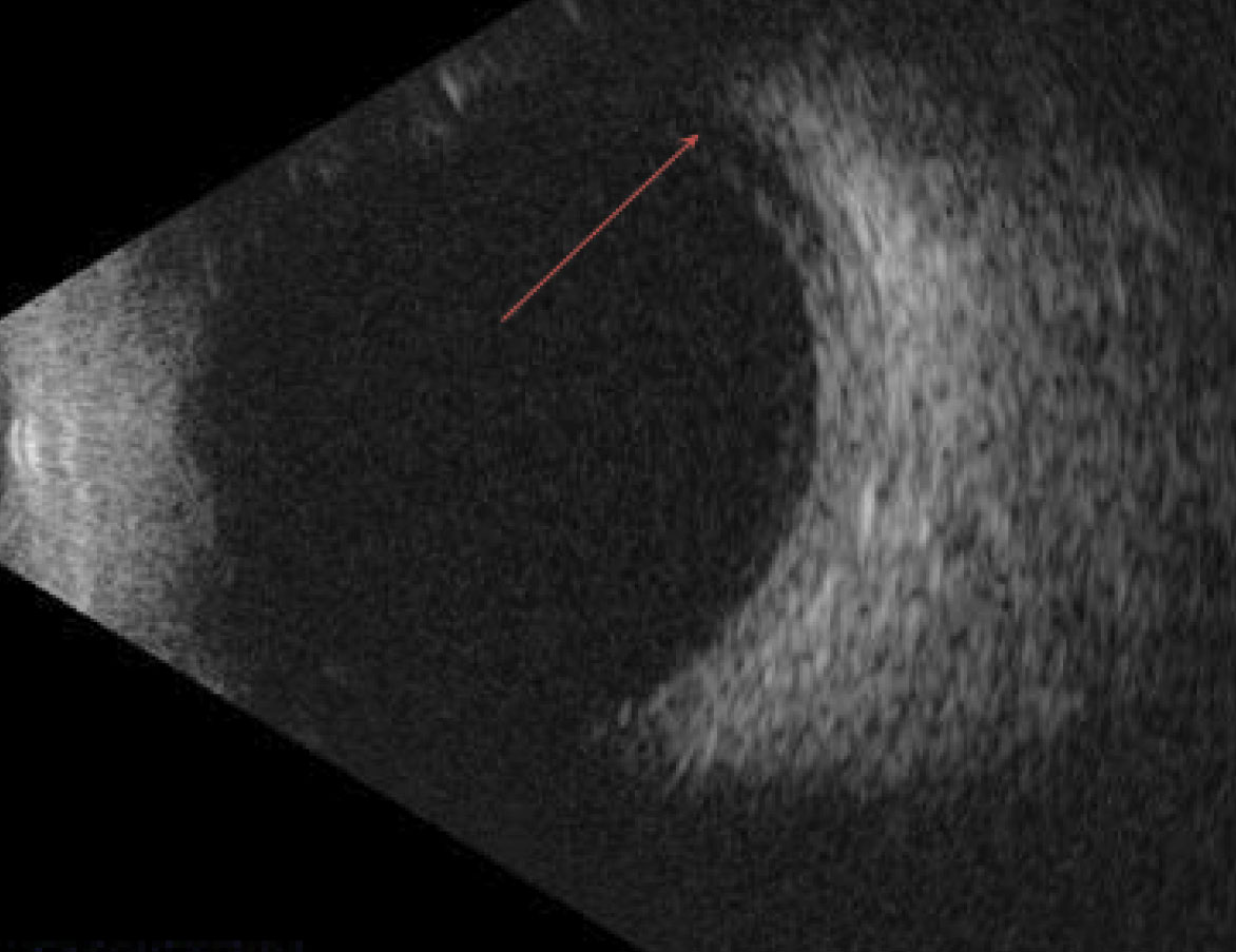 Fig. 3. Fluid in the superchoroidal space was observed using B-scan imaging.