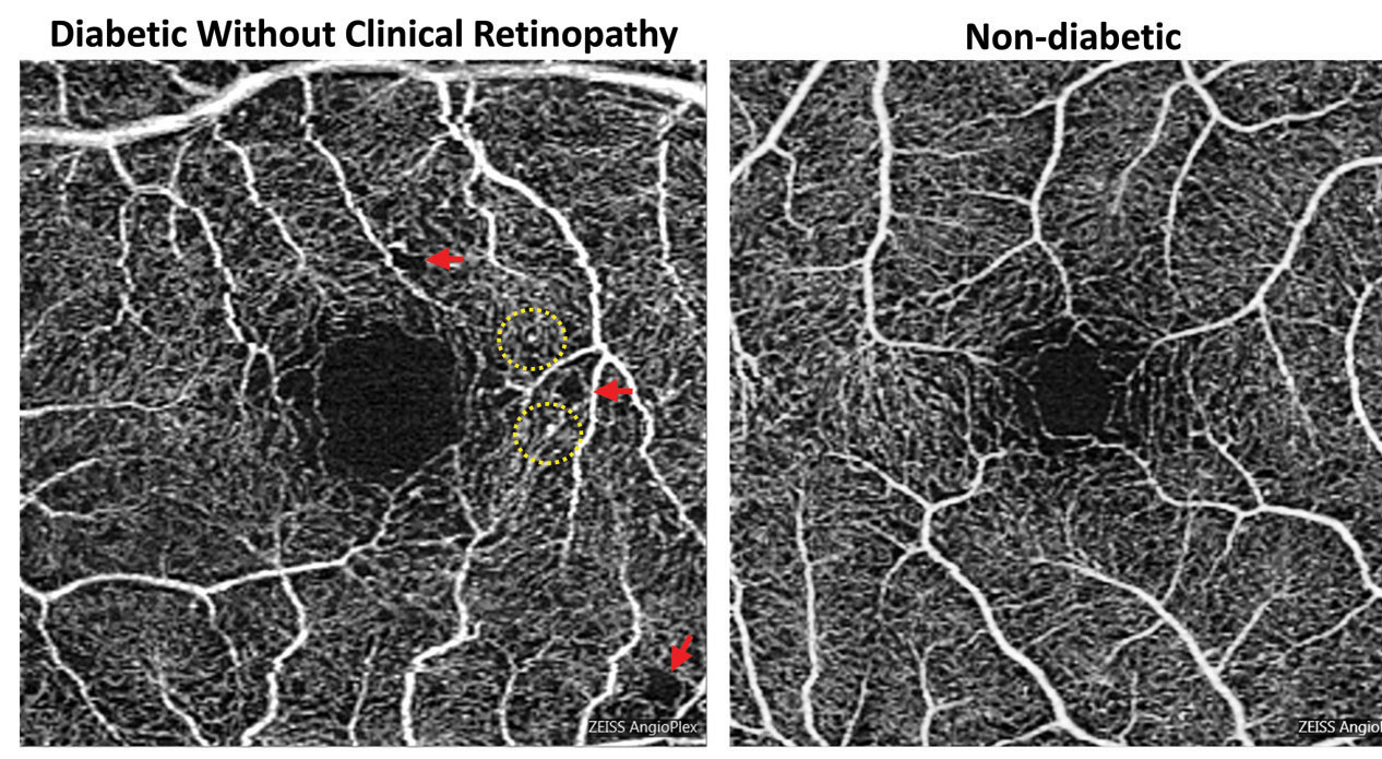 Foveal enlargement and perifoveal capillary remodeling detected with OCT-A in a diabetic eye without funduscopically visible diabetic retinopathy. Red arrows point to subtle areas of capillary nonperfusion, while yellow circles highlight microaneurysms. 