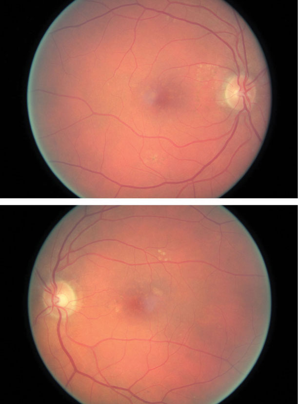 The patient’s color photography shows drusen with mild RPE changes in both eyes with mild macular thickening beginning in the left eye (bottom) that coincides with subretinal fluid identified with OCT.
