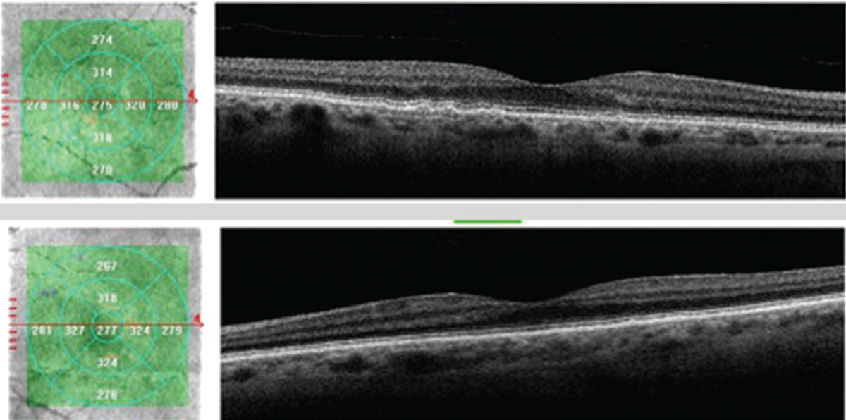 The patient’s OCT shows more prominent central drusen OD (top) compared with OS (bottom); however, small drusen are definitively present OU. The OCT confirms no macular atrophy or increased thickness for concern of CNVM at this time.