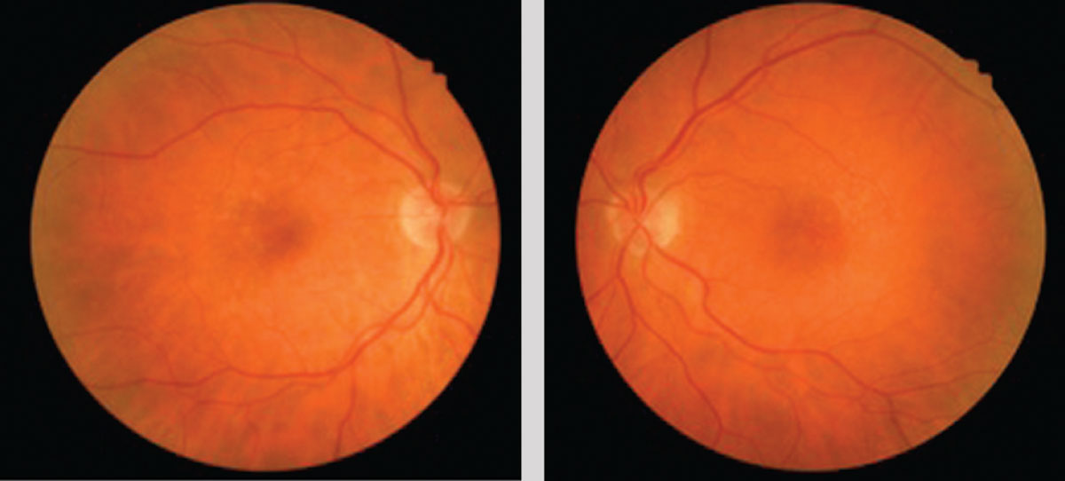 The patient’s macular color photographs show small hard, deep, drusen that is overall symmetric in both eyes.