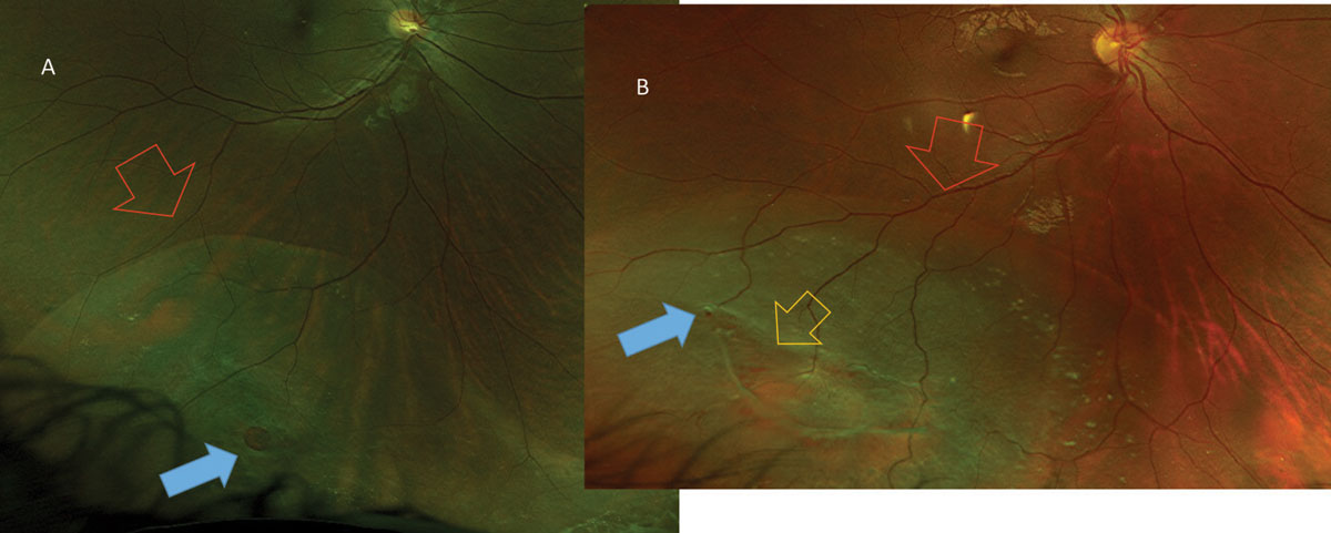 Fig. 5. Chronic inferotemporal retinal detachments (red arrows) noted in these asymptomatic patients. In one patient (A) the atrophic hole (blue arrows) is an isolated finding, whereas in a different patient (B) the atrophic hole (blue arrow) is associated with lattice degeneration (yellow arrow).