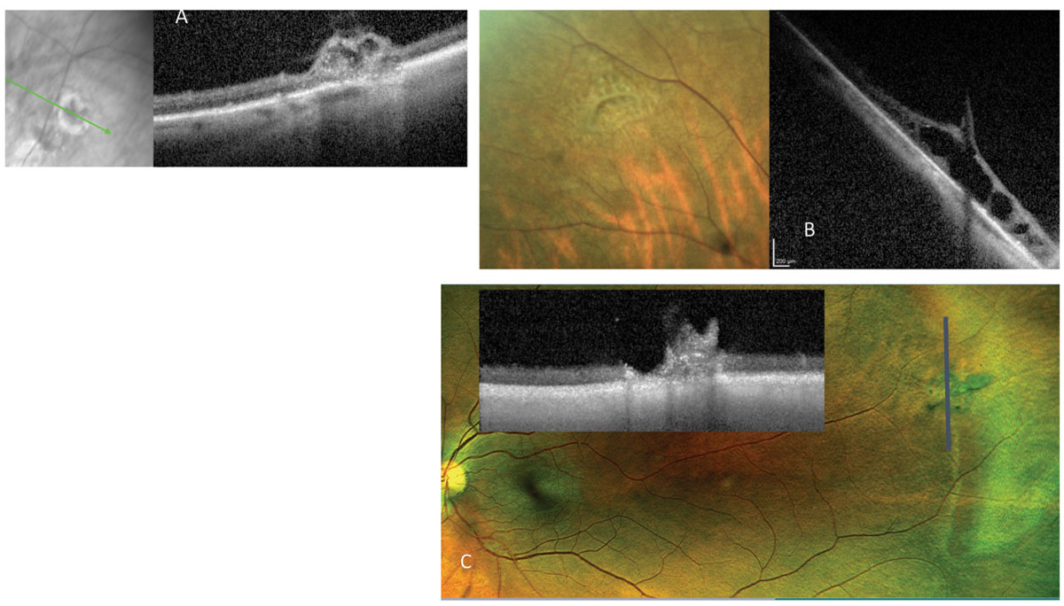 Fig. 7. Vitreous tufts are congenital vitreoretinal developmental anomalies. They can present as (A) non-cystic tuft, (B) cystic tufts or (C) tufts with an adjacent partial-thickness hole, seen here on fundus and OCT images.