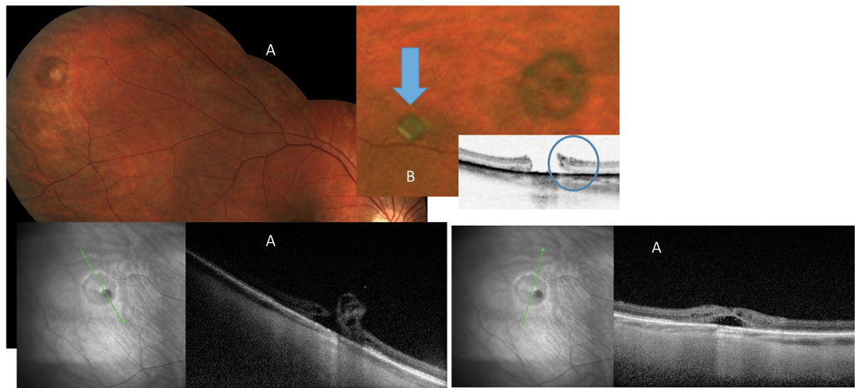 Fig. 8. These images show examples of round operculated holes. In (A) the patient’s operculum remains attached to the edge of the retinal hole. On OCT the cuff of fluid is noted surrounding the hole. In a different patient (B), although the operculum is released in the vitreous cavity (blue arrow), the edge of the retinal hole is lifted, allowing fluid to access the subretinal space (blue circle).
