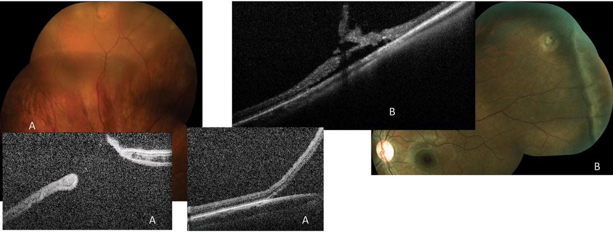 Fig. 9. These cases display irregular retinal breaks with localized subretinal fluid, causing subclinical rhegmatogenous retinal detachments. The first patient (A) requires surgical intervention, either pneumatic (followed by retinopexy) or vitrectomy with gas and laser to repair the retinal detachment, since the excessive fluid around the retinal hole will not allow laser alone to be effective. The second (B) can be treated by prophylactic laser.