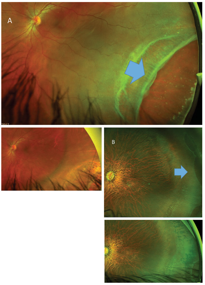 Fig. 16. Above, (A) retinal dialysis associated with RRD treated by scleral buckle. At right (B), multiple dialyzed areas in the absence of retinal detachment were treated by prophylactic laser.