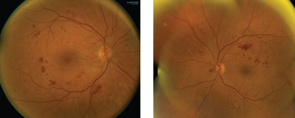 Fig. 1. These fundus images show the right and left eye of our patient. Note the extent of involvement. 
