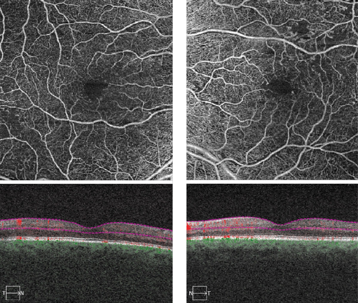 Fig. 2. These OCT-A images represent 6x6mm of the right and left eyes. Note the changes within each macula.
