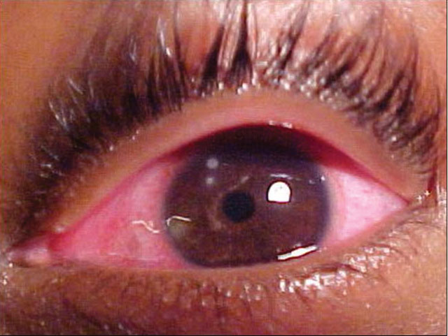 This 67-year-old woman is blind in her left eye, but her family was concerned that the eye itself was shrinking. Can this external examination help explain her condition?