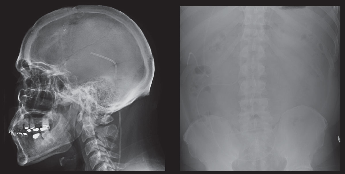 These scans show skull and abdomen radiographs of a patient who is post-ventriculoperitoneal shunt placement for pathological increase in CSF.