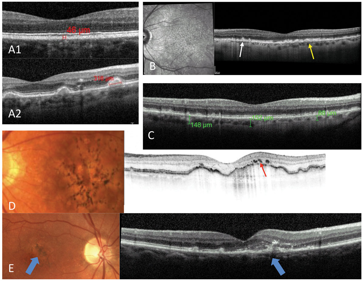 Fig. 2. Possible OCT findings in AMD: small drusen (A1), large drusen (A2), presence of both typical sub-RPE drusen (yellow arrow) and RPD, with lipofuscin deposits above the RPE (white arrow) and the pattern of RPD discernable on the infrared photo (B). Thinner than average choroidal thickness consistent with AMD (C). Pigmentary changes over large pigment epithelial detachments (red arrow) (D). Early detection of CNV (blue arrows) (E).