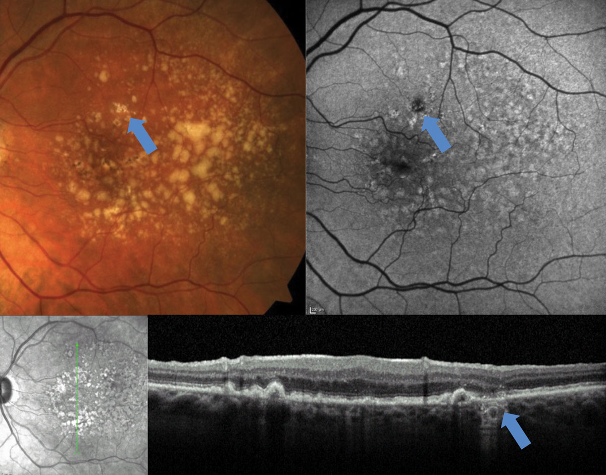 Fig. 4. This early area of GA, identified with FAF and OCT, would be difficult to detect on fundus examination.