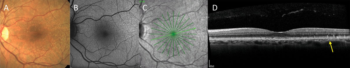 Fig. 5. Fundus photo (A), FAF (B), infrared image (C), and OCT (D) of  a patient with small to intermediate size drusen on clinical examination. No pigmenatry changes or large drusen are present, suggesting the risk for progression to advanced stages is low. However, FAF and OCT reveal the presence of RPD, which is known to carry increased risk of advanced AMD.
