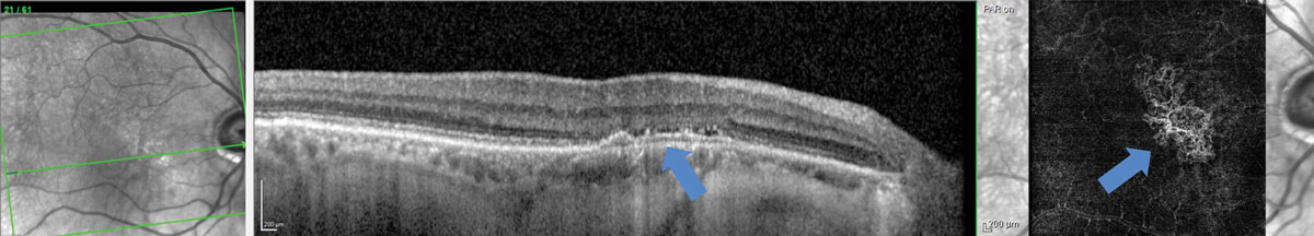 Fig. 6. Type 1 sub-RPE choroidal neovascular membrane with minimal evidence of exudation on OCT but evidence of neovascular net in the avascular region on OCT-A.