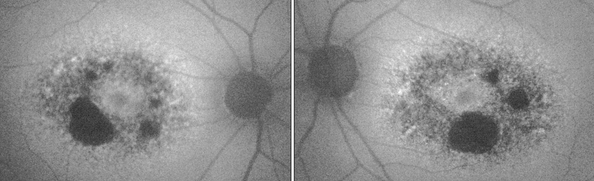 Fig. 2. In the patient’s fundus autofluorescence, the dark areas show RPE atrophy, while the surrounding areas of hyper-fluorescence indicate lipofuscin deposits.