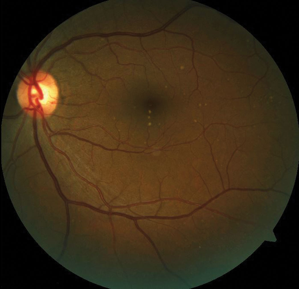 This patient has subretinal drusen deposits in the macular region.