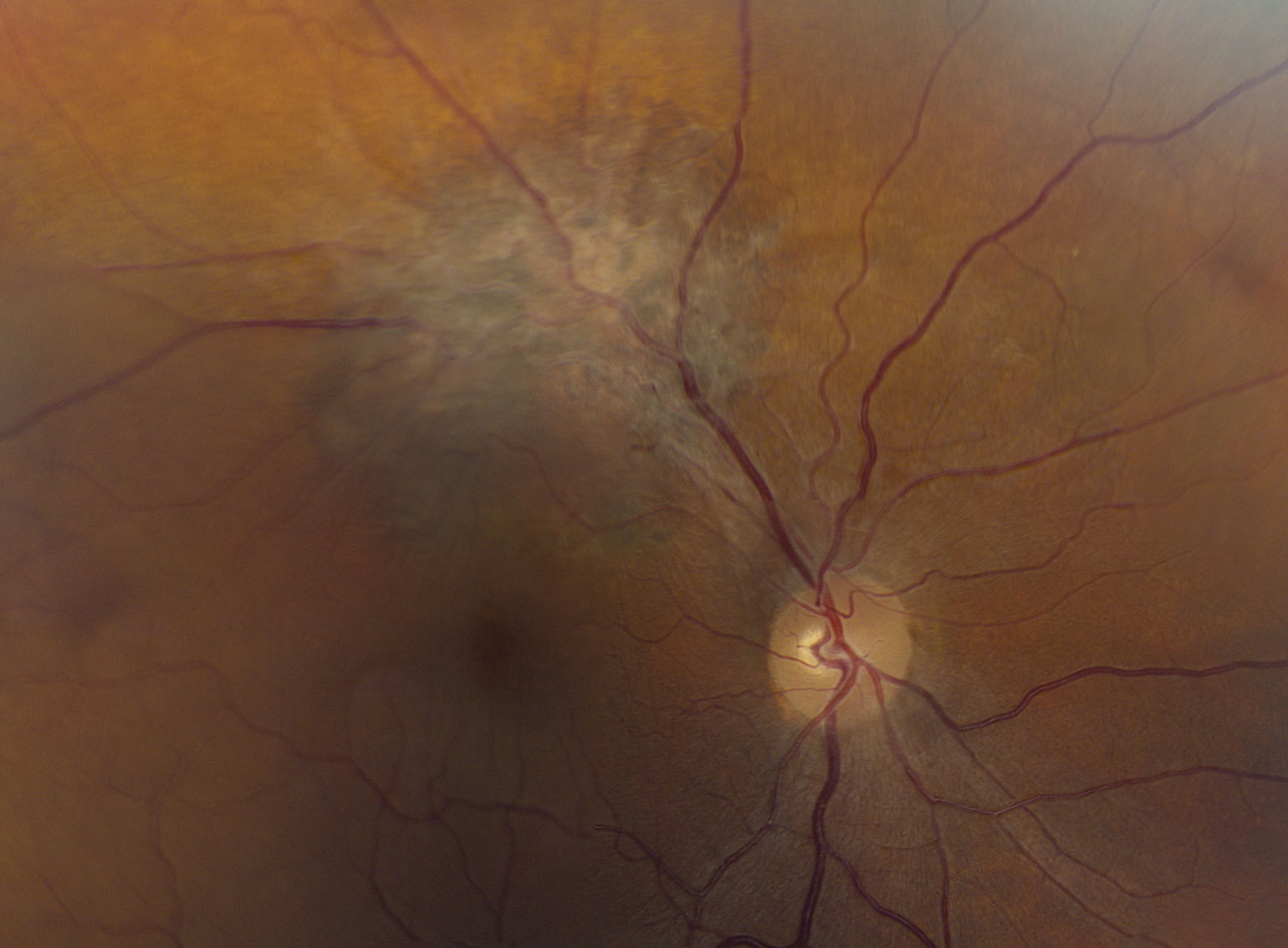 Fig. 1. A widefield view of the right eye of our patient. 