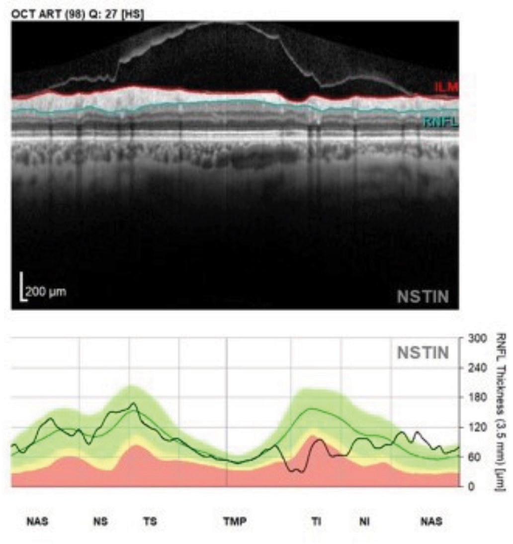 Fig. 2. This perioptic RNFL circle B scan image and NSTIN plot shows a patient with glaucomatous structural damage in the inferotemporal sector. Note the contiguity of the entire temporal RNFL scan in this format.
