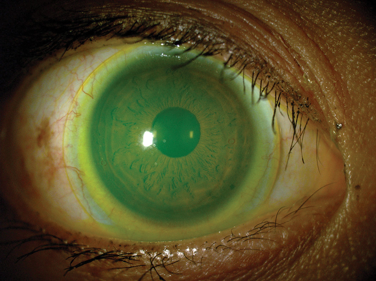 A specialty lens, such as this mini-scleral, may be a good option for your patient with high corneal astigmatism—and one only you can prescribe.