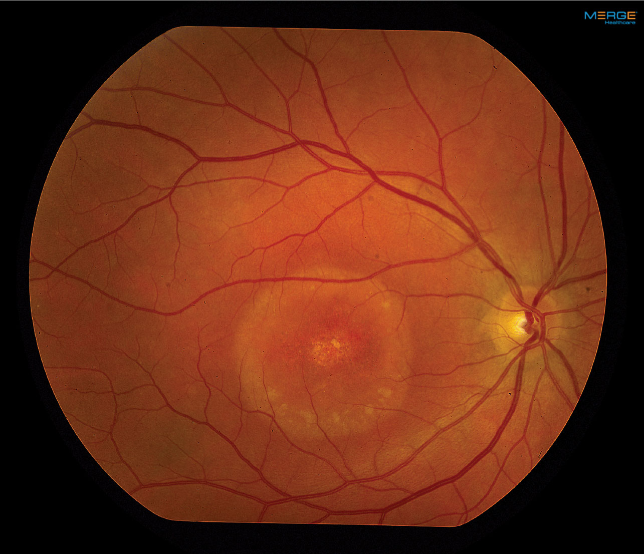 Our patient’s fundus photos reveal changes in the right macula. 