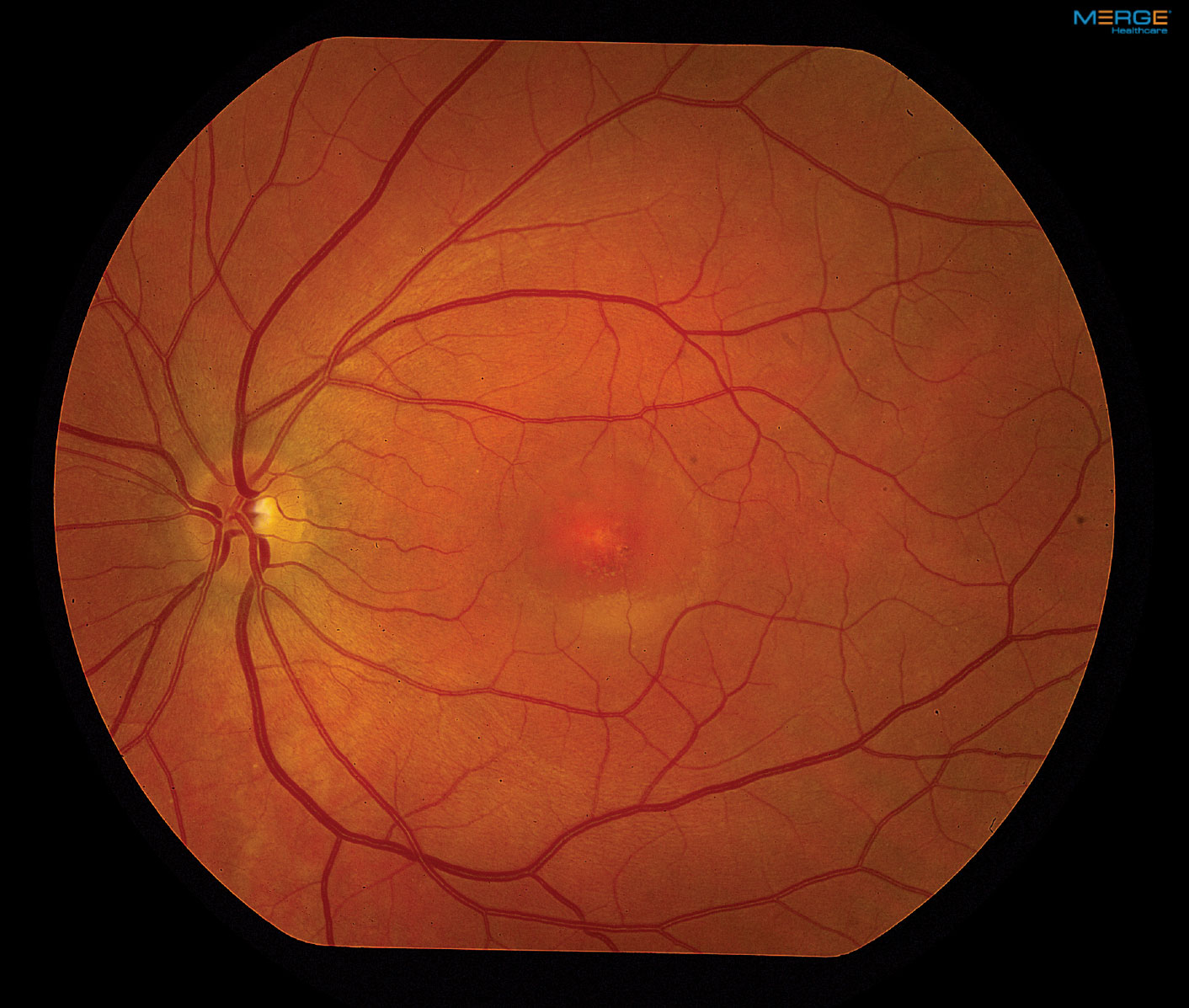 Our patient’s fundus photos reveal changes in the left macula.