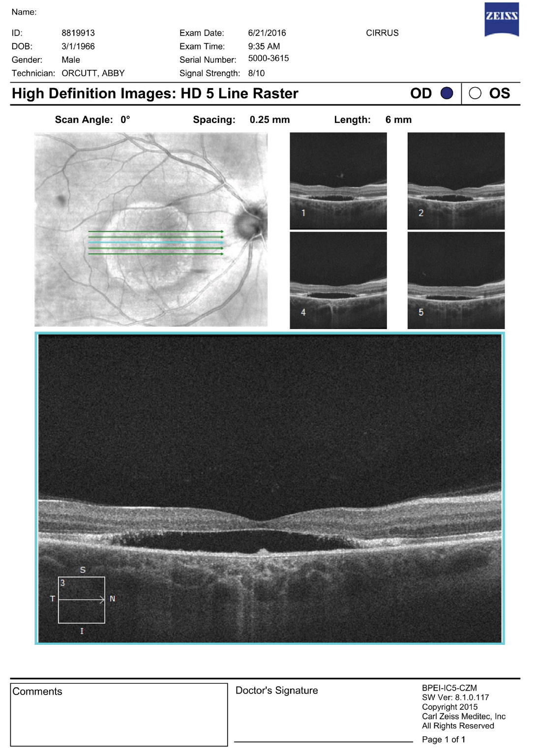 OCT imaging of the right macula. What are the striking features?
