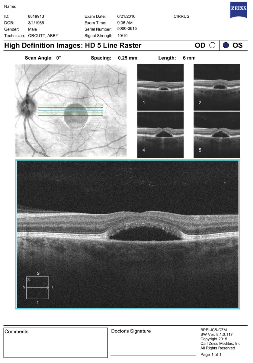 OCT imaging of the left macula. What are the striking features?