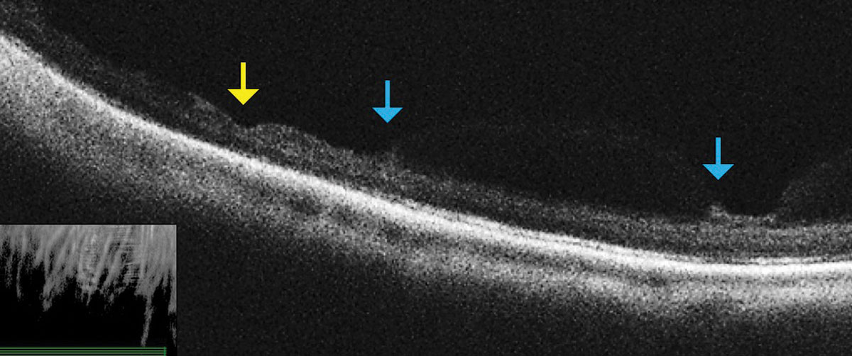 Fig. 3. This OCT raster scan taken through an area of lattice degeneration in the inferior peripheral fundus shows retinal thinning (yellow arrow) bordered by vitreous condensation/vitreoretinal traction. OCT does not reveal any full-thickness breaks. 