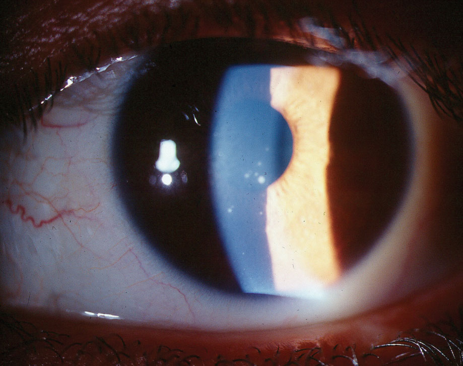 This patient demonstrates centrally located keratic precipitates in glaucomatocyclitic crisis.
