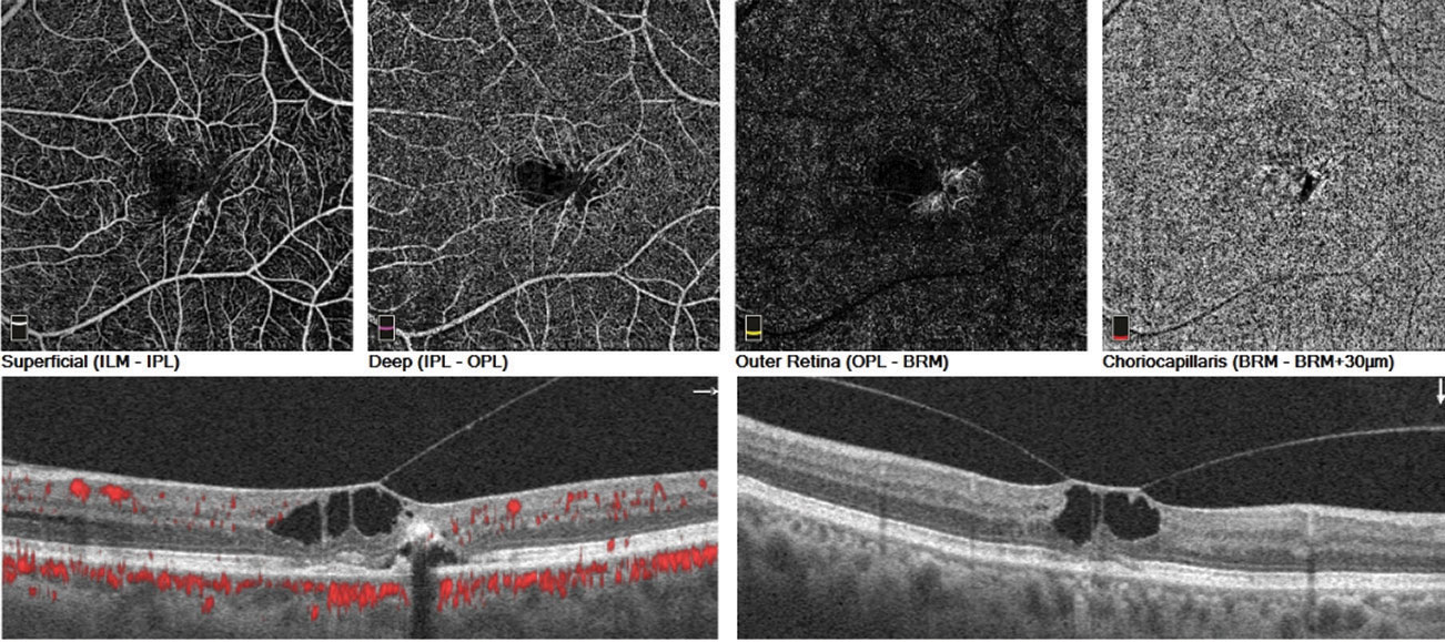 These images showcase OCT angiography’s ability to image macular telangiectasia.