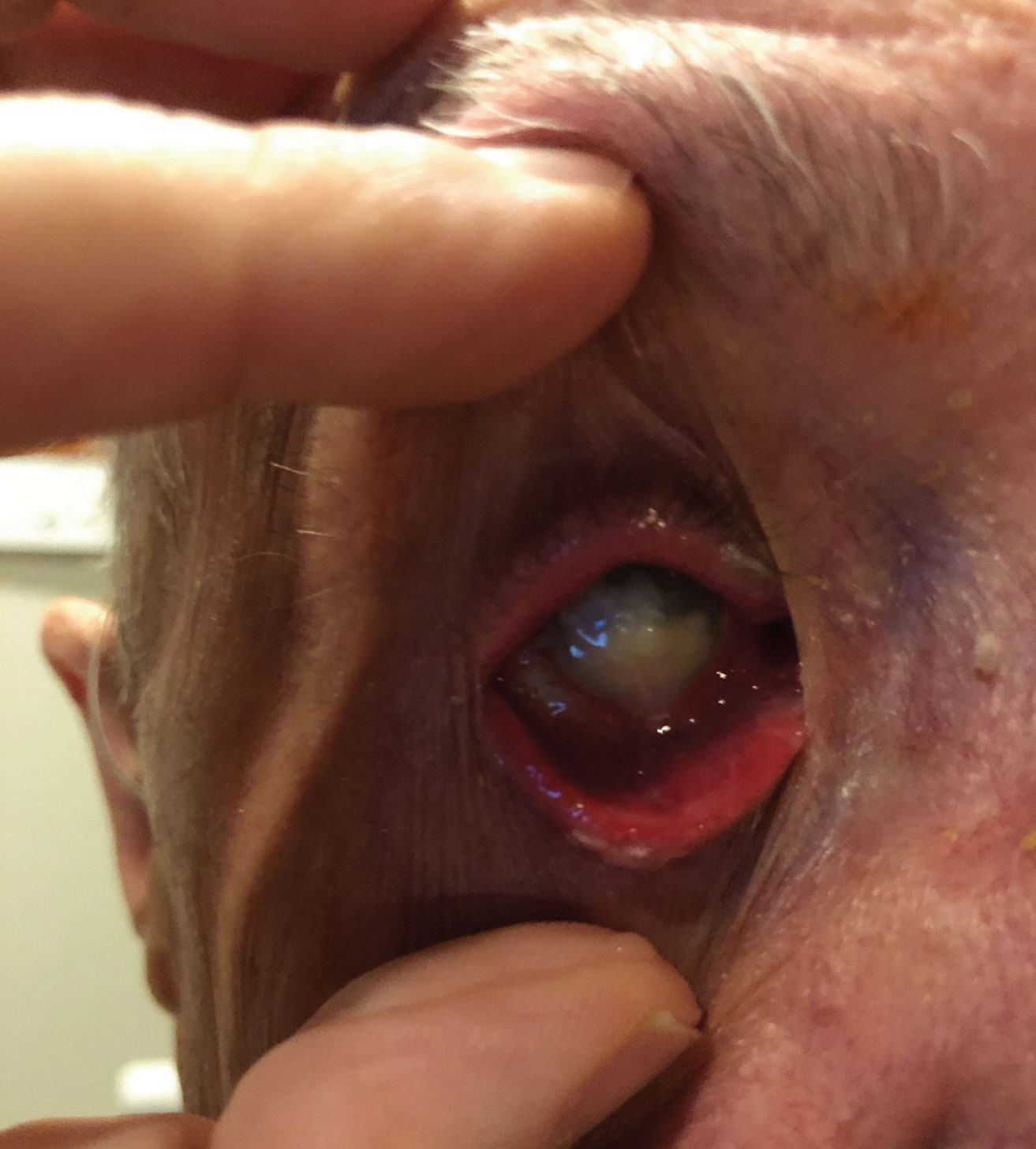 This patient presented with severe pain secondary to endophthalmitis that he developed after being noncompliant following a corneal transplant.