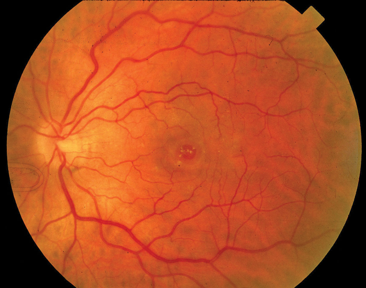 Fig. 1. This patient’s three-month history of vision loss was due to a full-thickness macular hole.
