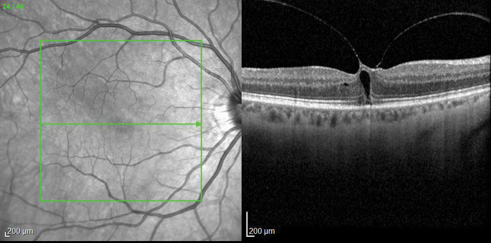 Fig. 3. OCT imaging revealed an impending macular hole as the cause of this patient’s visual complaints.