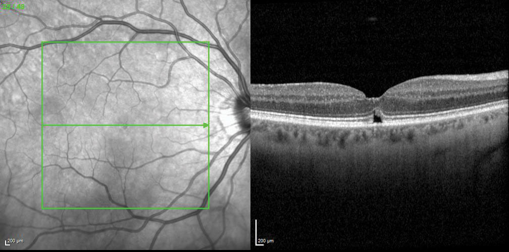 Fig. 4. Pneumatic vitreolysis helped release the posterior hyaloid and close the macular hole.