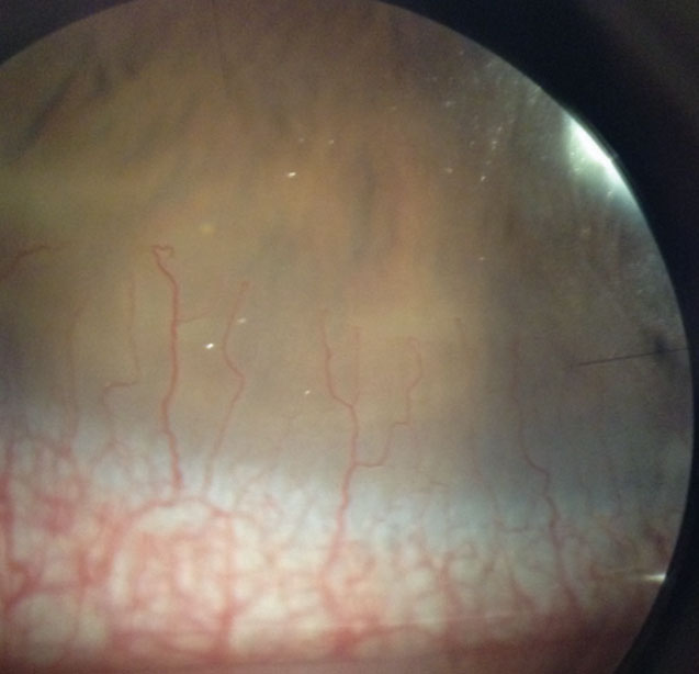 Fig. 4. This asymptomatic patient’s corneal neovascularization is due to contact lens overwear.