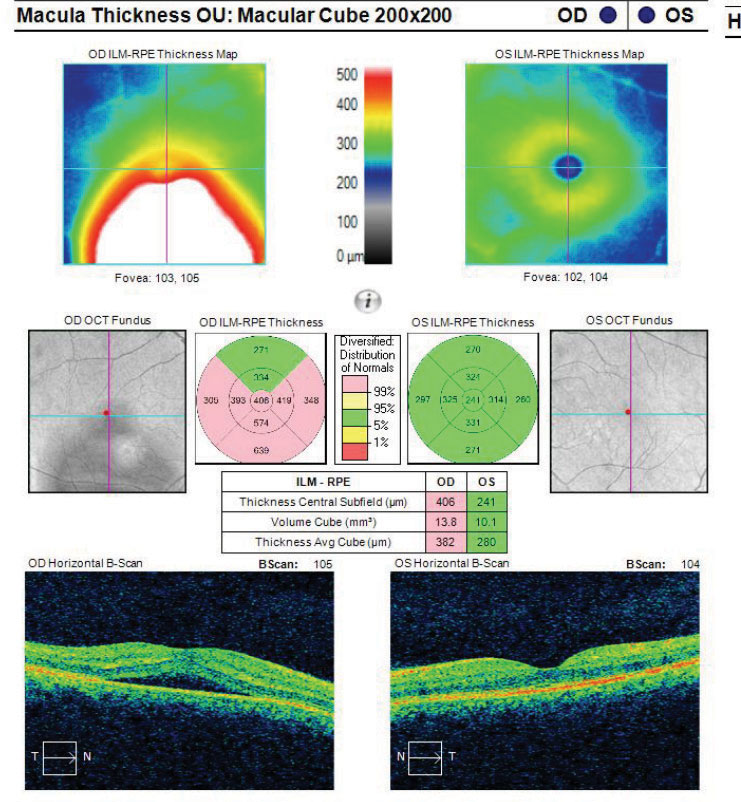 Fig. 8. This macular cube image demonstrates a patient with RPE disruption with CSCR. 