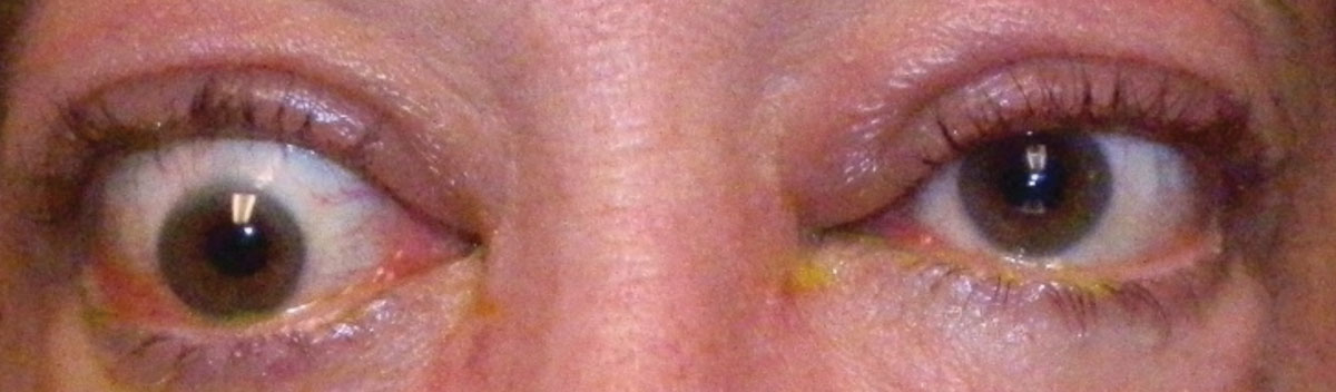 Fig. 1. Hypotropia of the right eye in a patient with TAO.