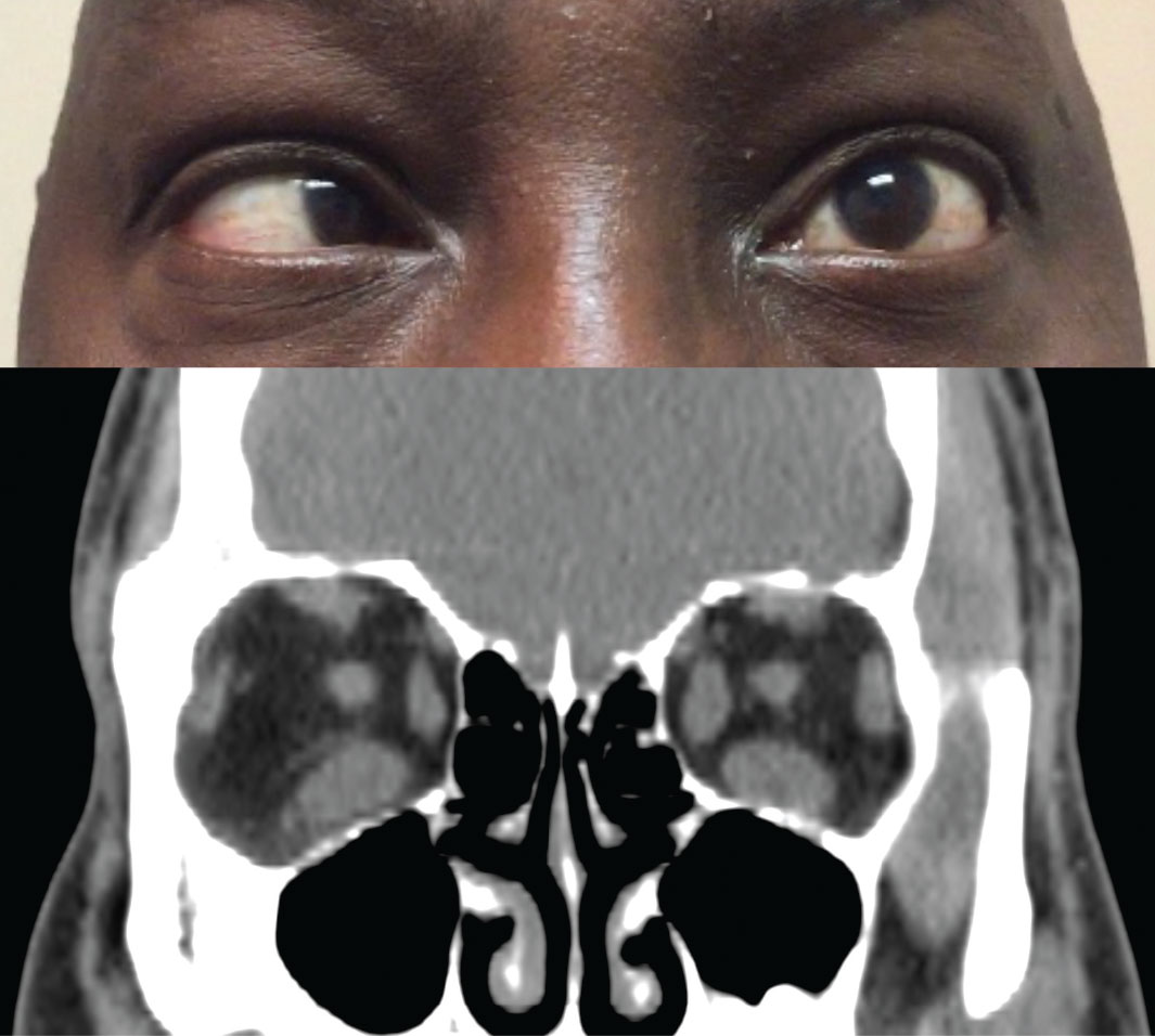 Fig. 2. Above, restricted movement of the left eye in temporal gaze. Below, coronal CT scan of the orbits shows an increased thickness of the left medial rectus and both inferior recti.
