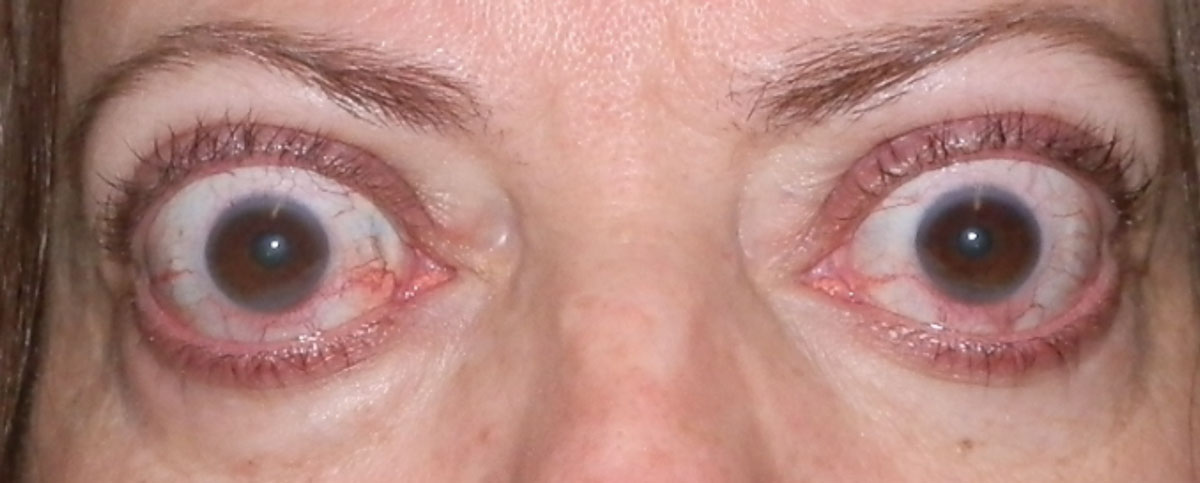 Fig. 3. Upper eyelid retraction and proptosis in a patient with orbital congestion (conjunctival injection) in the active phase. 