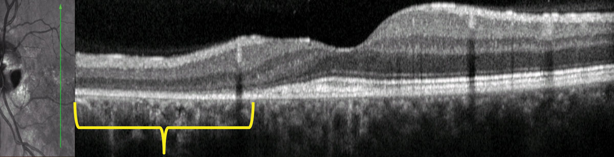 OCT imaging of the patient seen above shows outer retinal disruption (in yellow brackets, top), indicative of possible serous detachment in the past. 