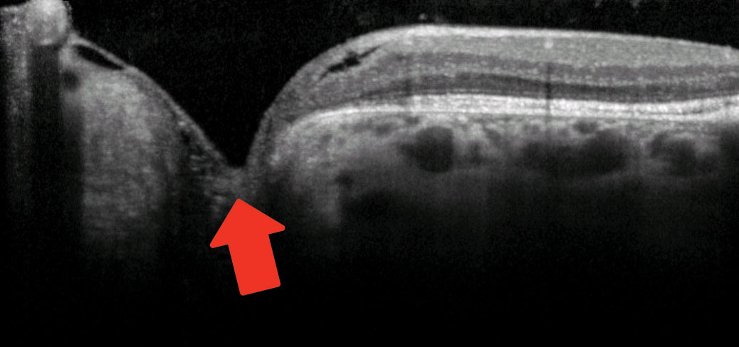 Cavitation in the area of the pit is shown with the red arrow.