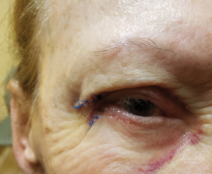 Post-op overcorrection of ptosis could cause upper eyelid retraction and exposure keratitis.