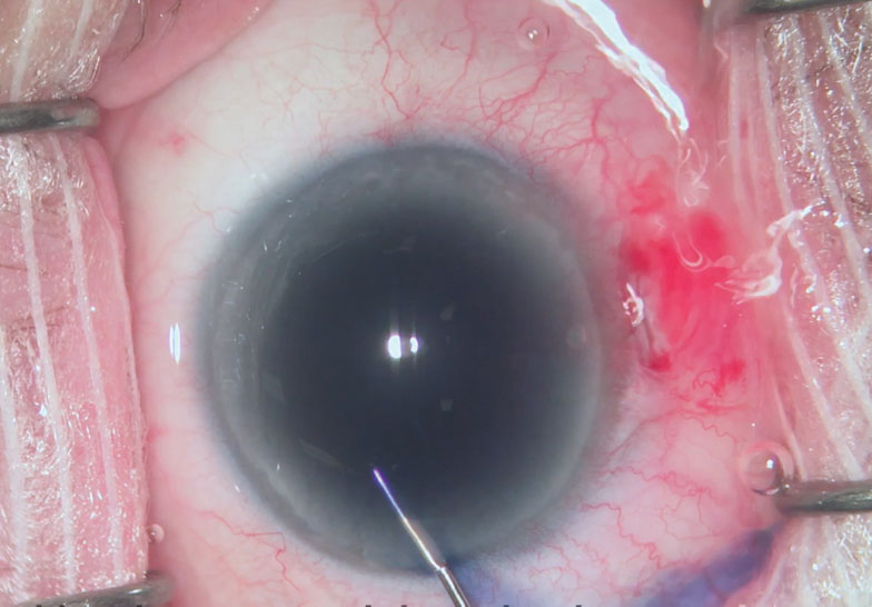 Fig. 1. The surgeon injects the vital dye through the side-port incision to increase visibility during cataract surgery.